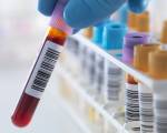 Xét nghiệm máu tầm soát sớm hơn 50 bệnh ung thư