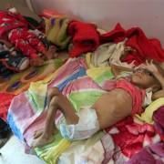 Hơn 85.000 trẻ em chết vì đói và bệnh tật tại Yemen trong 3 năm qua