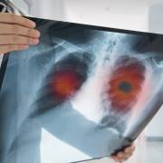 AI chẩn đoán ung thư phổi giỏi hơn bác sĩ