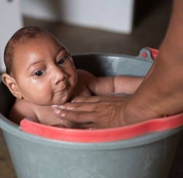 Tỷ lệ sinh con mắc bệnh đầu nhỏ tăng gấp 20 lần từ khi virus Zika xuất hiện