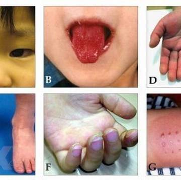 Đà Nẵng: Bé 3 tháng tuổi mắc bệnh Kawasaki hiếm gặp may mắn cấp cứu kịp