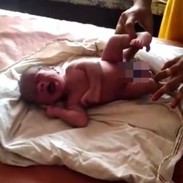 Sinh đôi ký sinh: Cậu bé ra đời với 4 chân, 2 bộ sinh dục