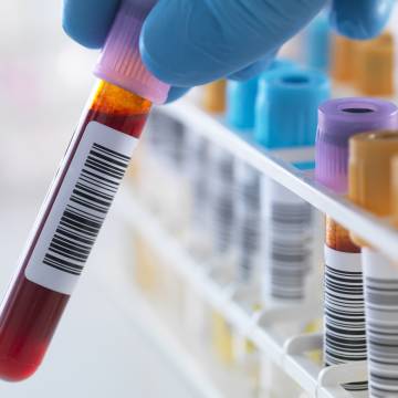 Xét nghiệm máu tầm soát sớm hơn 50 bệnh ung thư